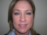 Brow Lift