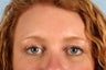 Brow Lift