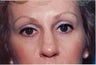 Brow Lift
