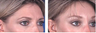Brow lift at age 39