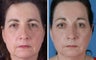Endoscopic Browlift and Upper and Lower Eyelid Surgery