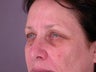 Brow Lift 