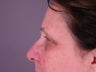 Brow Lift 