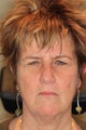 Endoscopic Brow Lift with Bilateral Upper Blepharoplasty