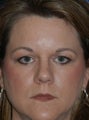 Brow Lift & Upper Eyelid Surgery