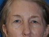 Brow Lift