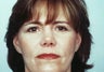 Endoscopic Brow Lift and Blepharoplasty to lower eyelid