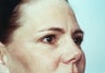 Endoscopic Brow Lift and Blepharoplasty to the lower eyelids