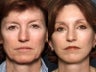 Brow Lift
