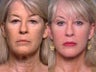 Brow lift