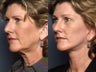 Brow Lift