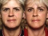 Brow Lift