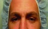 Endoscopic Brow lift