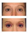 Brow lift