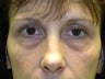 Brow Lift