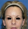 Endoscopic Browlift