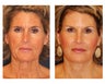 Facial Rejuvenation