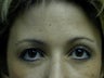 Brow Lift