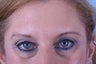 Endoscopic browlift, upper and lower blepharoplasty (eyelids)
