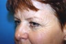 Browlift