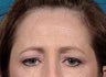 Brow Lift