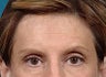 Brow Lift