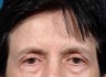 Brow Lift