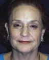 Brow Lift 