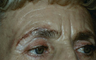 forehead lift