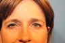 Blepharoplasty and Forehead Lift