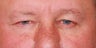 Endoscopic Browlift