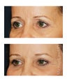 Brow Lift