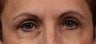 Brow rejuvenation