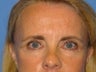 Browlift & Lower Blepharoplasty