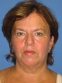 Open Browlift, Facelift, Upper & Lower Blepharoplasty