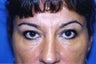 Browlift