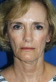 Browlift