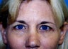 Brow Lift with Blepharoplasty