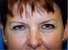 Brow Lift with Blepharoplasty