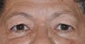 Browlift