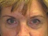 Brow Lift