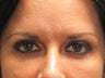 Brow Lift 