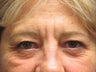 Brow Lift