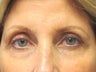 Brow Lift