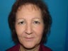 Endoscopic brow lift, upper and lore blepharoplasty, mid face lift and septal reset