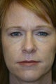 Brow Lift