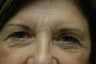 Forehead and Brow lift