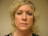 Brow Lift