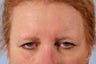 Brow Lift