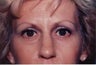 Brow Lift